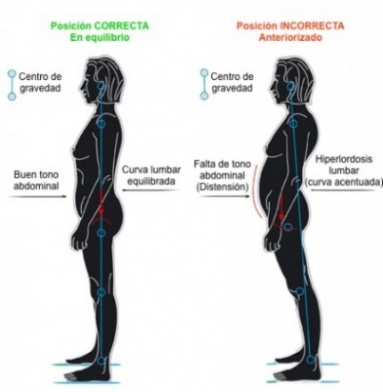 causas hiperlordosis lumbar